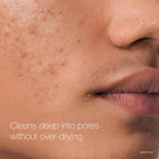 Transform Your Skin with Neutrogena Rapid Clear Maximum Strength Acne Face Pads - 60 Count of Powerful 2% Salicylic Acid Treatment for Clear, Blemish-Free Complexion